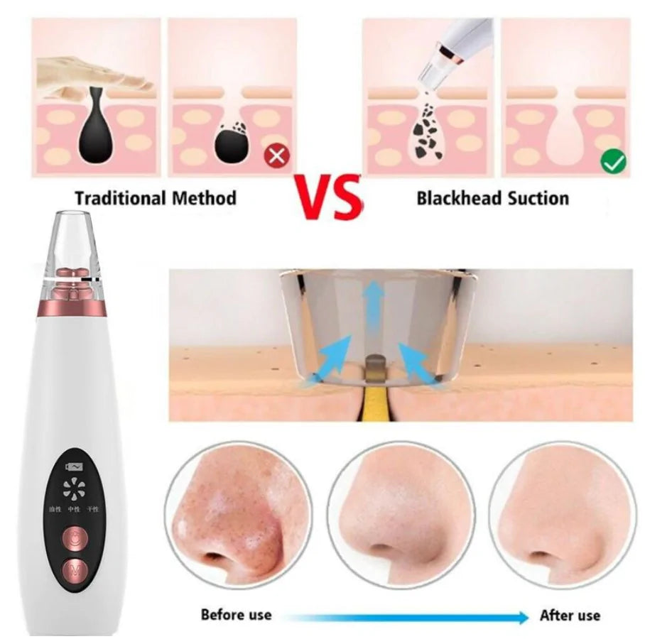 Pore Vacuum Blackhead Remover